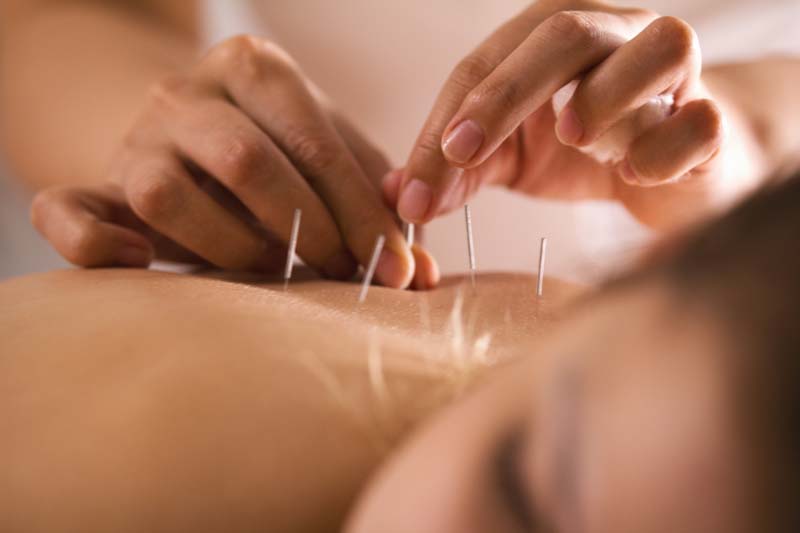 Acupuncture Ottawa