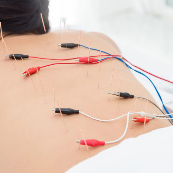 Électroacupuncture Gatineau